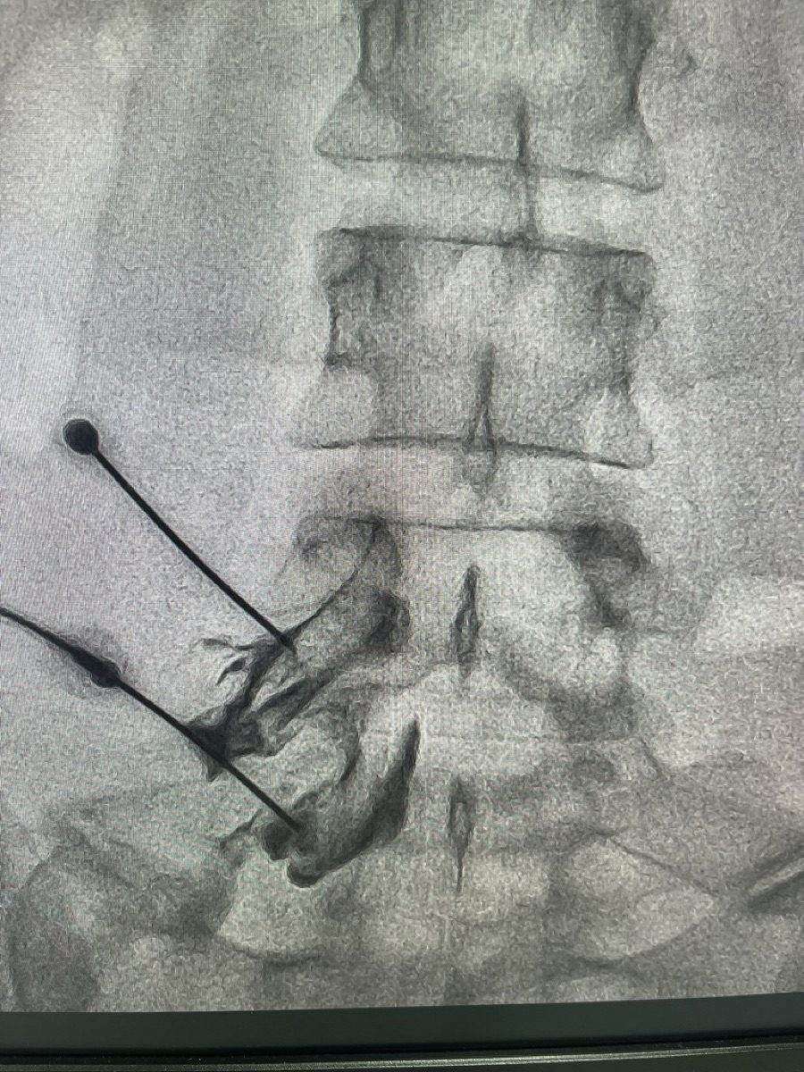 Epidural steroid injection being administered under fluoroscopic guidance