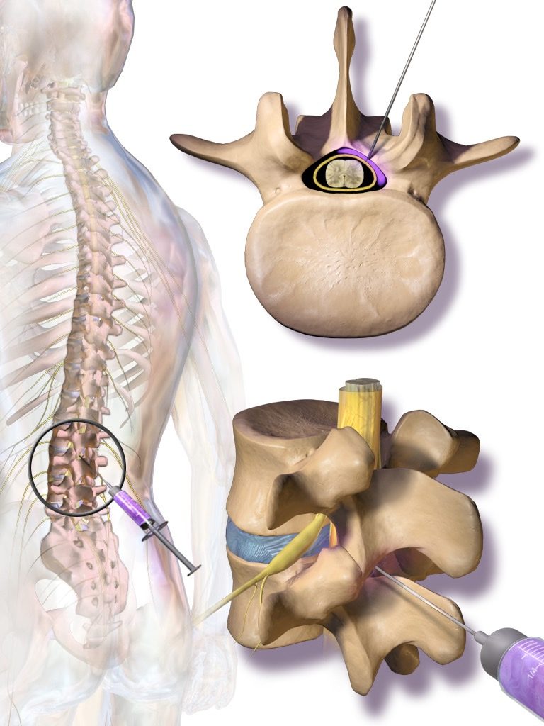 Epidural steroid injection versus spine surgery comparison