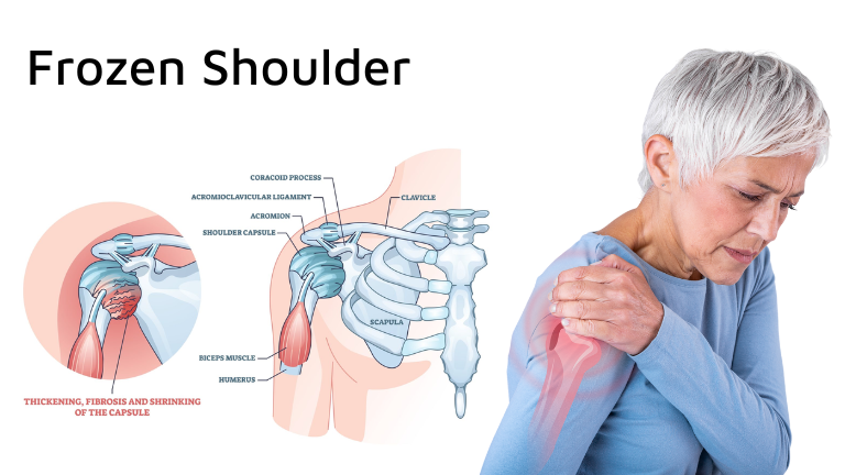 Frozen shoulder anatomy showing capsule thickening and shoulder pain