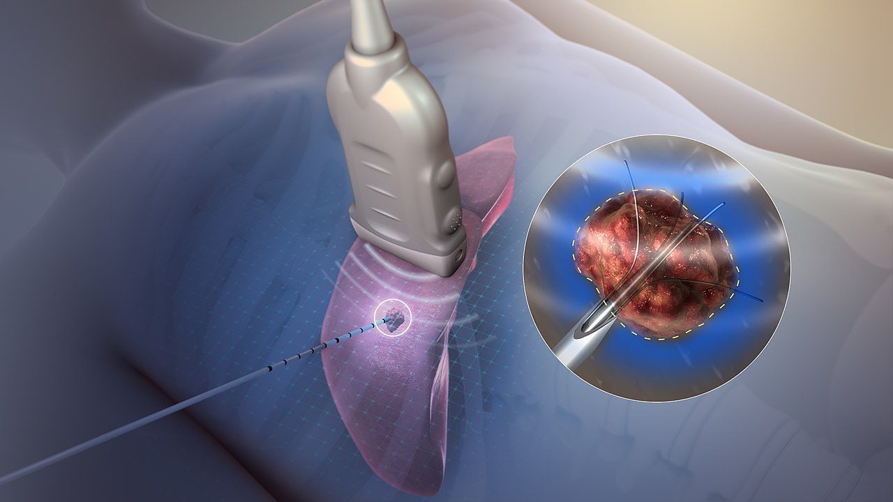 Radiofrequency ablation procedure explanation