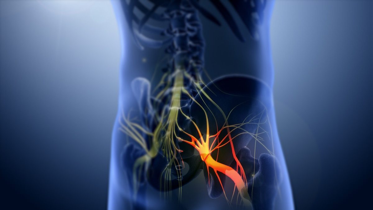 Illustration of herniated disc compressing sciatic nerve root