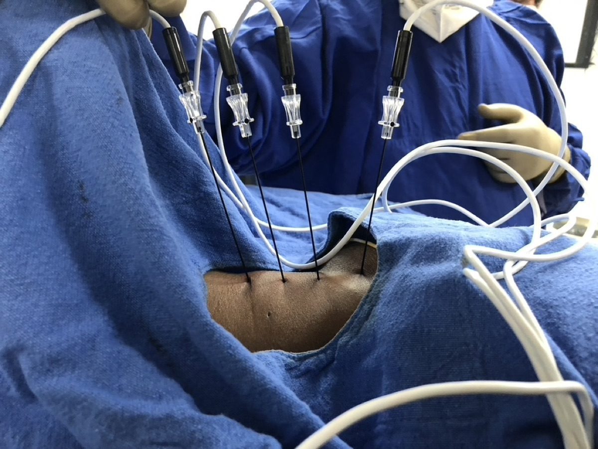 Cervical Facet RFA procedure
