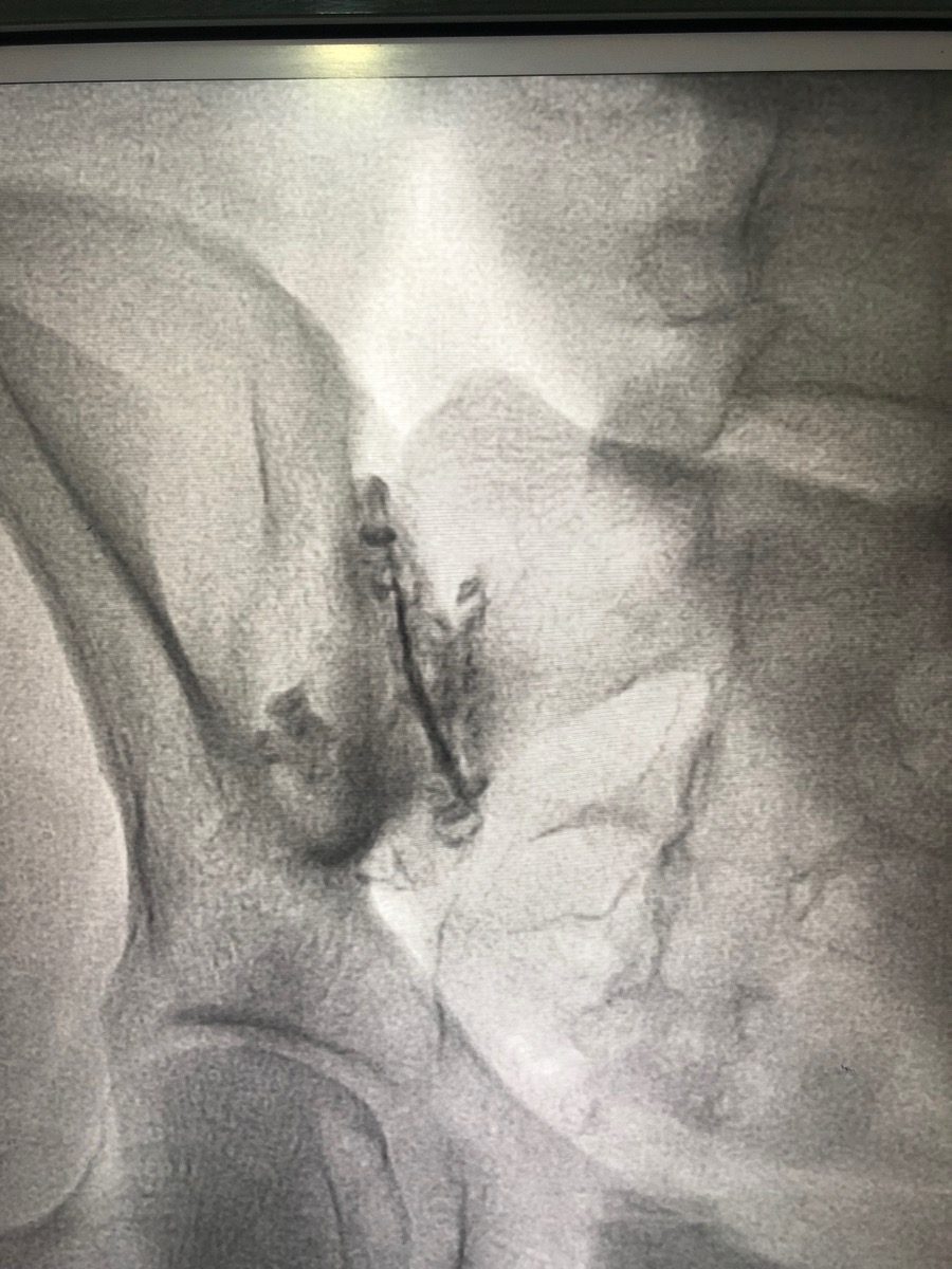Sacroiliac Joint Injection procedure