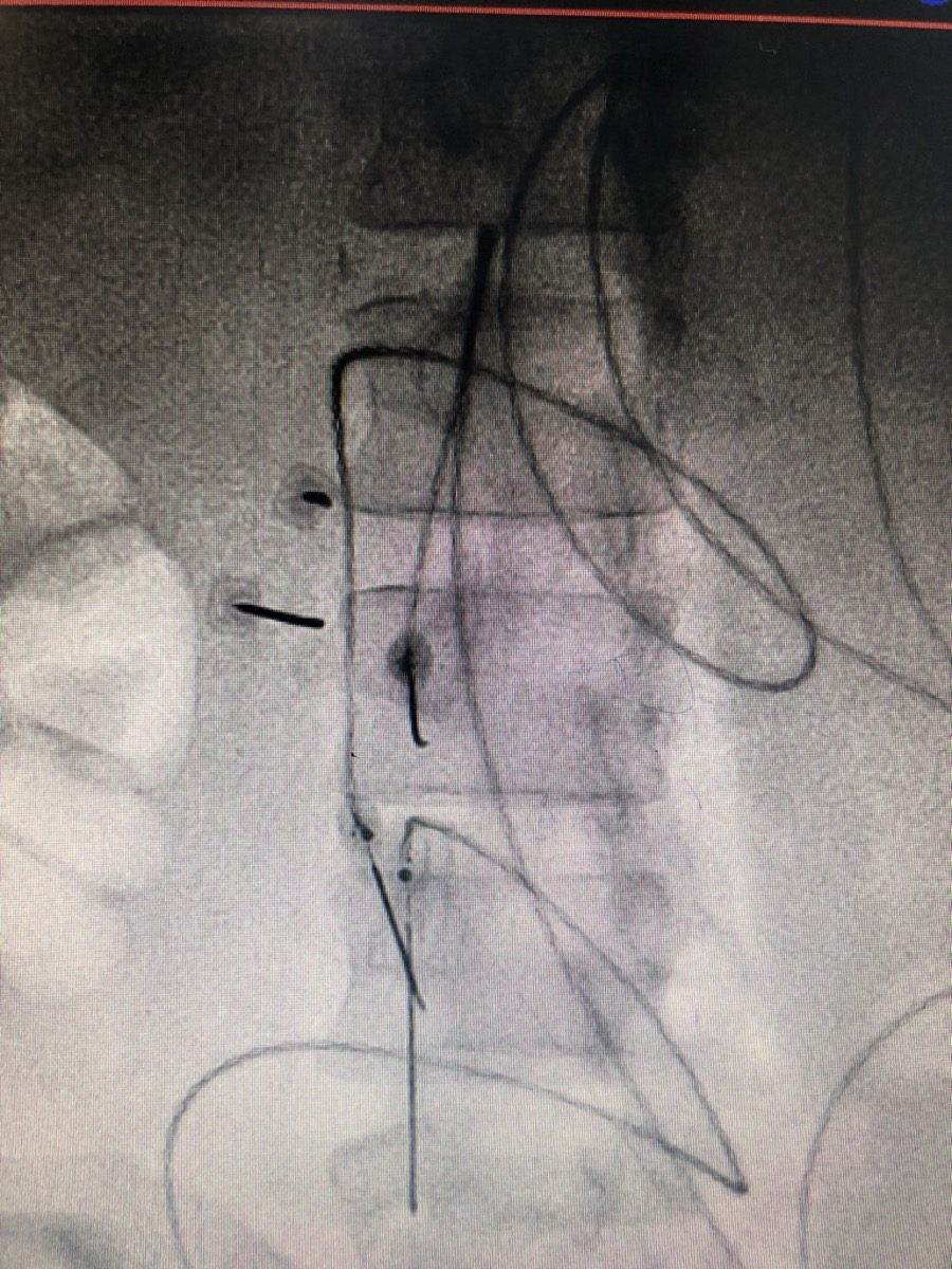 Pain specialist discussing treatment options with a patient experiencing phantom limb pain