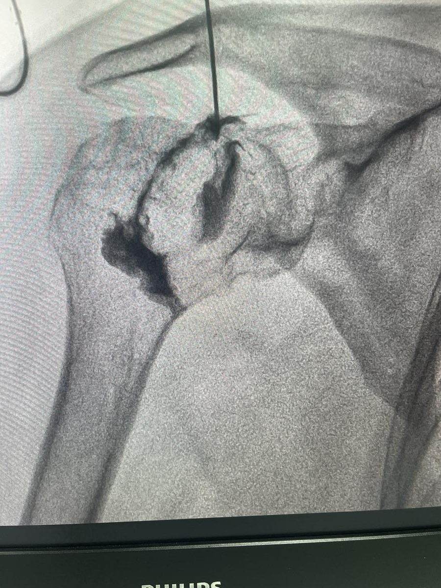 Doctor performing a shoulder injection procedure