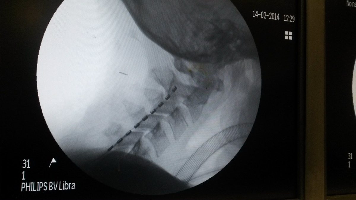 Pain specialist planning interventional treatment for a spinal cord injury patient