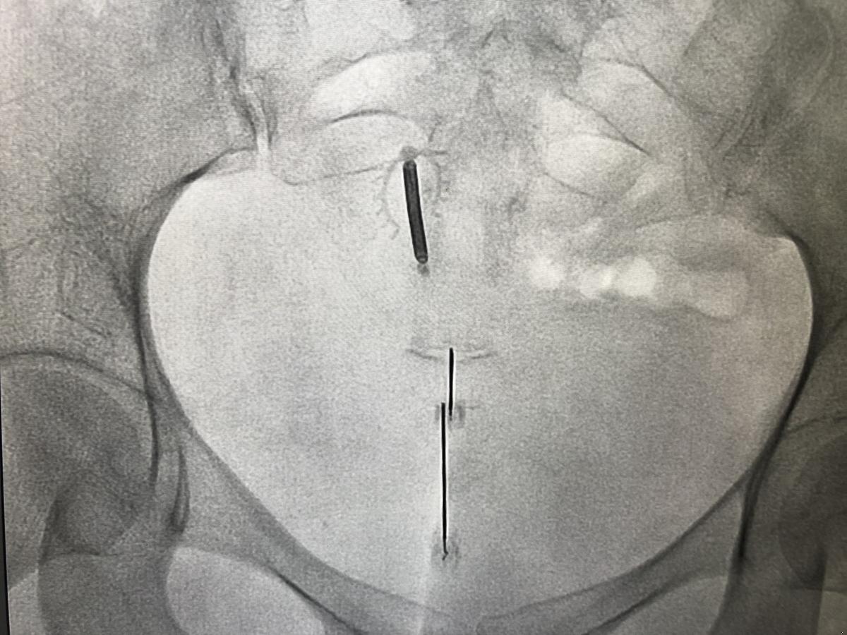 Doctor performing a coccyx injection procedure under image guidance